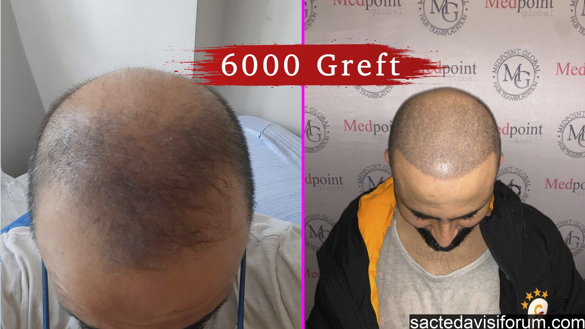 hair transplant 6000 greft.jpg