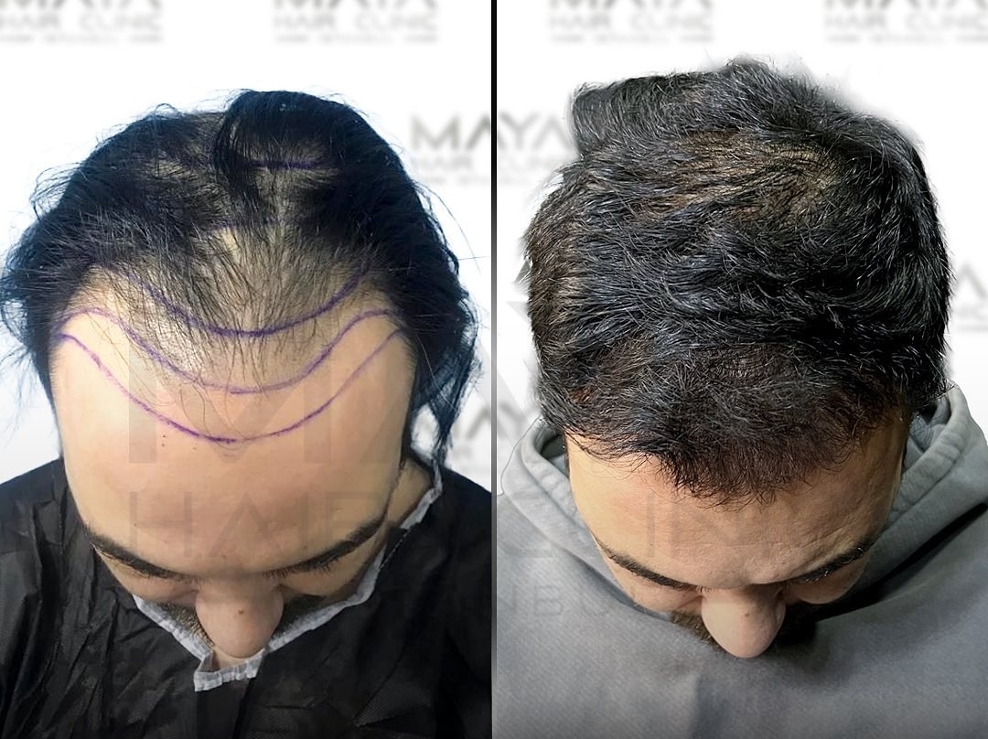 Maya Hair Clinic Saç Ekimi 3000 Greft.jpg